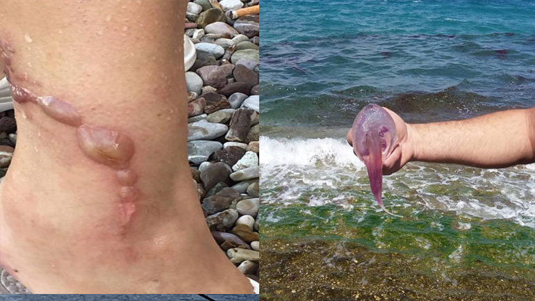 Συνεχίζεται η εισβολή μεδουσών στις ελληνικές θάλασσες – Στο νοσοκομείο λουόμενη στην Αχαΐα