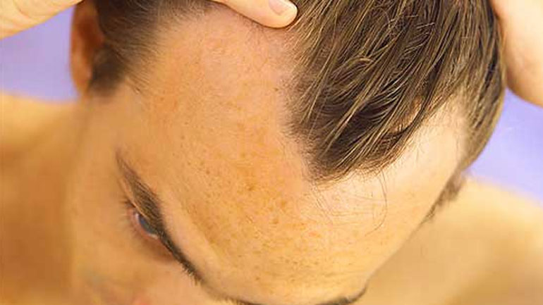 Ο ρόλος της διυδροτεστοστερόνης στην ανδρικού τύπου αλωπεκία Ο ρόλος της διυδροτεστοστερόνης στην ανδρικού τύπου αλωπεκία