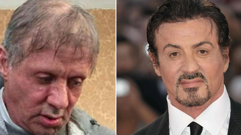 Σκιά του εαυτού του ο Sylvester Stallone! Κυκλοφόρησαν φήμες ότι πάσχει από καρκίνο