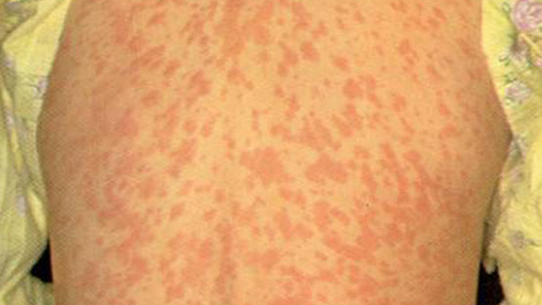 Κρούσμα ιλαράς στην Αιτωλοακαρνανία – Σε συναγερμό οι αρχές