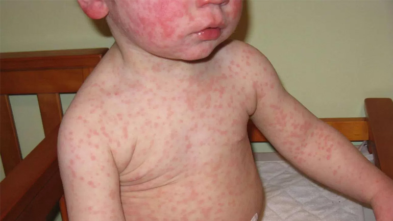 Η «ξεχασμένη» ιλαρά έκανε την εμφάνισή της – Τρία κρούσματα στην Κρήτη