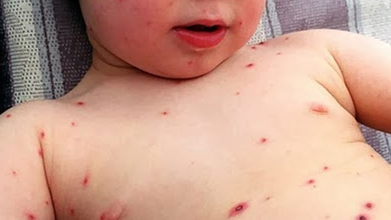 Στα 166 τα κρούσματα ιλαράς στην Ελλάδα