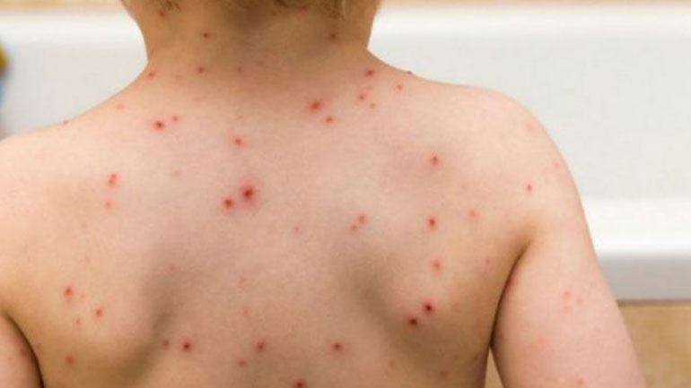 Σε εγρήγορση για τα κρούσματα ιλαράς το Υπουργείο Υγείας