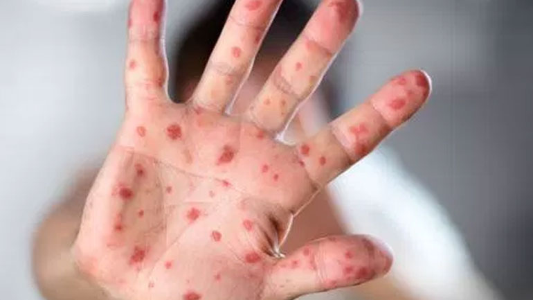 Τα 200 έφτασαν τα κρούσματα της ιλαράς