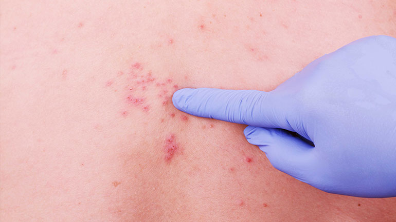 Εκστρατεία ενημέρωσης για τον έρπητα ζωστήρα