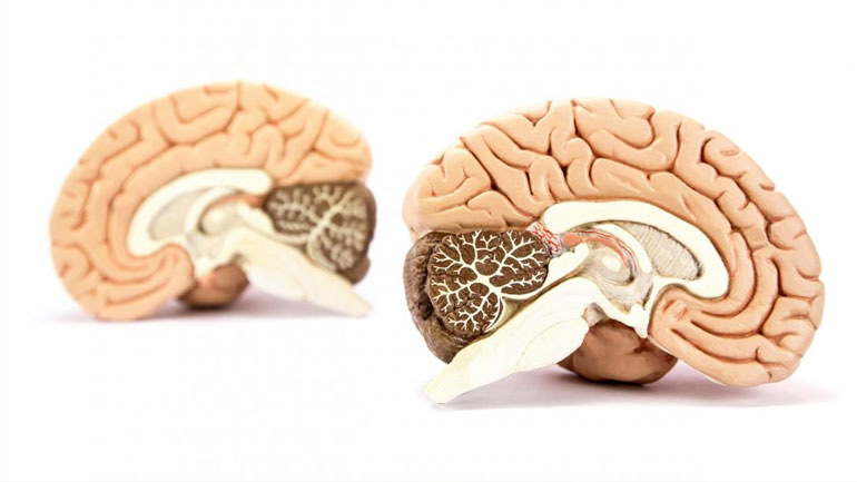 Έρευνα: Η σχιζοφρένεια διαταράσσει όλο το σύστημα επικοινωνιών του εγκεφάλου