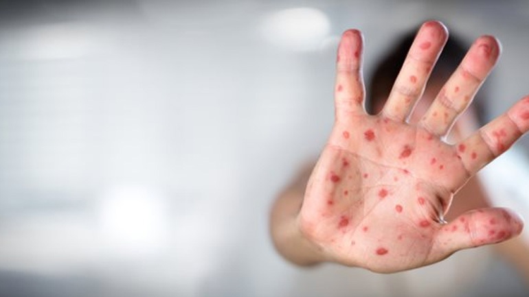 Ένα βρέφος έντεκα μηνών το πρώτο επιβεβαιωμένο θύμα της ιλαράς στην χώρα μας