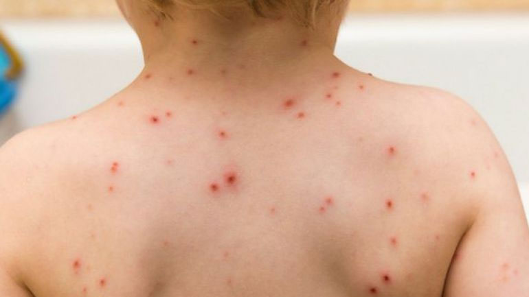 ΚΕΕΛΠΝΟ: Στα 405 ανήλθαν τα κρούσματα ιλαράς