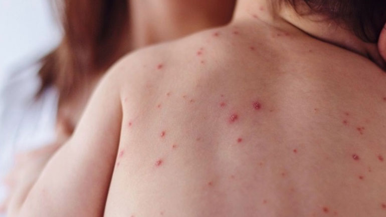 Στα 477 έφτασαν τα κρούσματα της ιλαράς