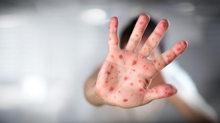 ΚΕΕΛΠΝΟ: 80 νέα κρούσματα ιλαρά μόνο την τελευταία εβδομάδα