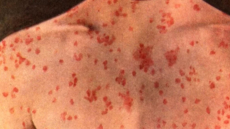 Πάτρα: 17χρονος μαθητής πέθανε από ιλαρά