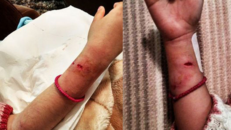 Λέσβος: Αδέσποτα σκυλιά επιτέθηκαν σε επτάχρονη Λέσβος: Αδέσποτα σκυλιά επιτέθηκαν σε επτάχρονη