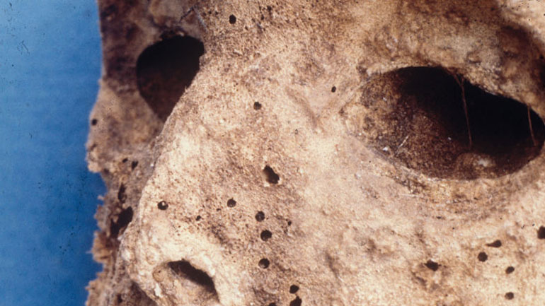 Επιστήμονες ανακάλυψαν ηπατίτιδα Β στη μούμια ενός παιδιού από τον 16ο αιώνα