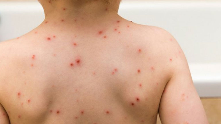 Στα 1.185 τα καταγεγραμμένα κρούσματα της ιλαράς