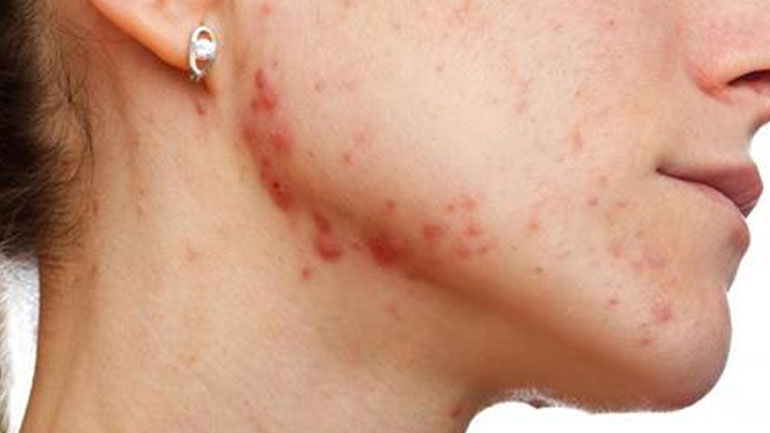 Αυξημένος ο κίνδυνος κατάθλιψης μετά την εμφάνιση ακμής στο πρόσωπο, ιδίως στις γυναίκες