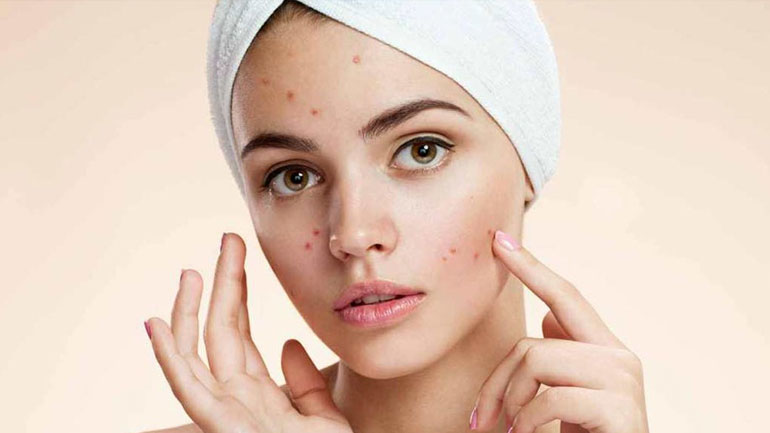 Αυξημένος ο κίνδυνος σοβαρής κατάθλιψης μετά την εμφάνιση ακμής στο πρόσωπο