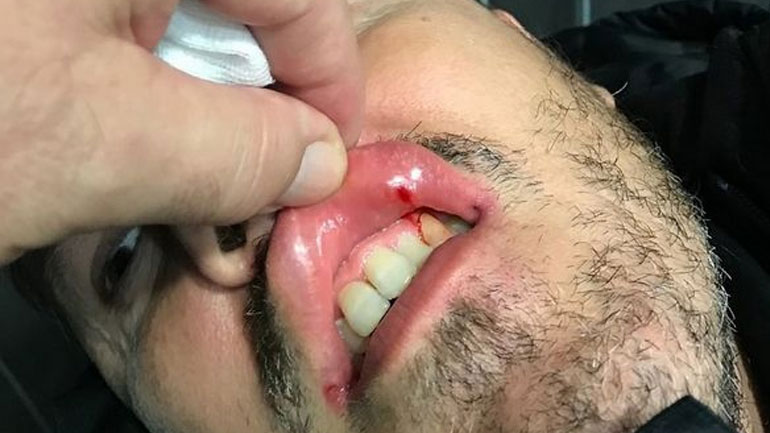 Oλυμπιακός: Δημοσιοποίησε φωτογραφίες με τον τραυματισμό του Γκαρθία