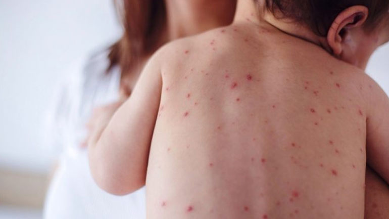 Σε εξέλιξη η επιδημία ιλαράς στην Ευρώπη