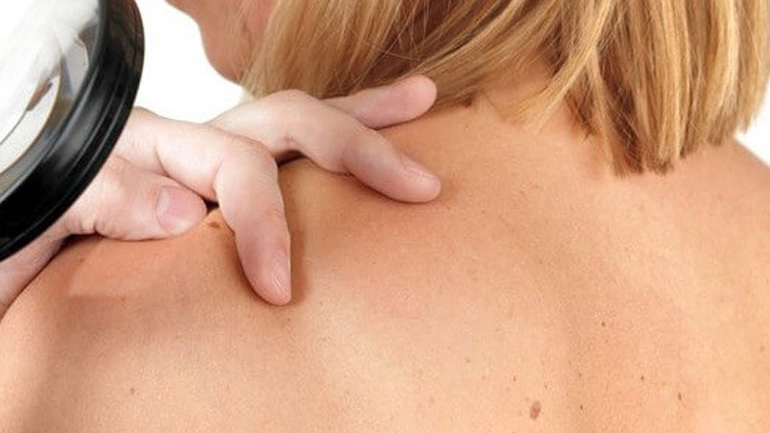 Νέα γονίδια ευθύνονται για τον καρκίνο του δέρματος