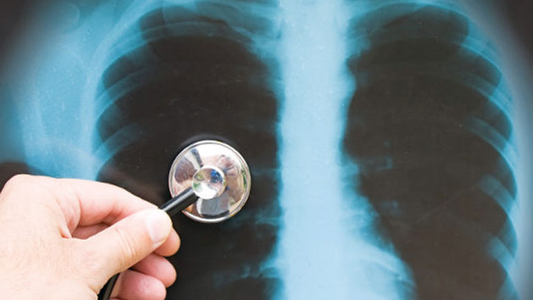 Παρούσα στην Ελλάδα η φυματίωση