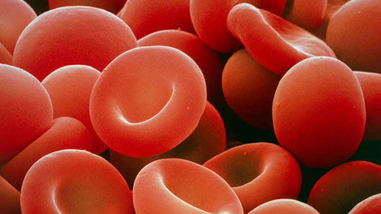 Έρευνα: Ασφαλής και αποτελεσματική μια νέα γονιδιακή θεραπεία για τη μεσογειακή αναιμία