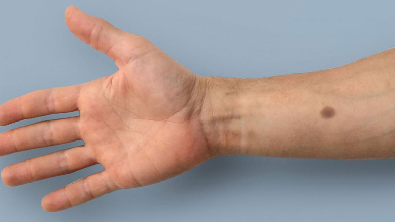 Ερευνητές ανέπτυξαν το πρώτο εμφύτευμα που προδίδει τον πρώιμο καρκίνο