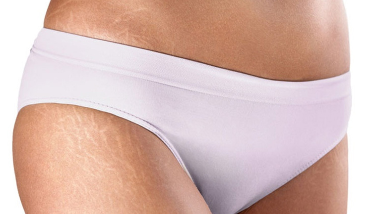 Μπορούν οι ραγάδες να αντιμετωπιστούν με κρέμες;