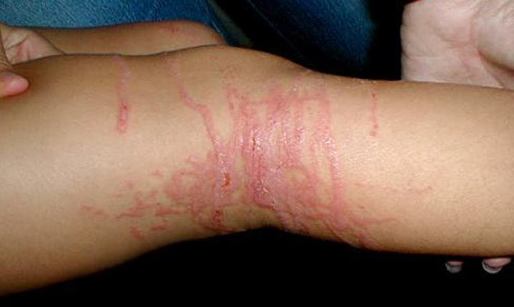 Τσίμπημα από μέδουσα 