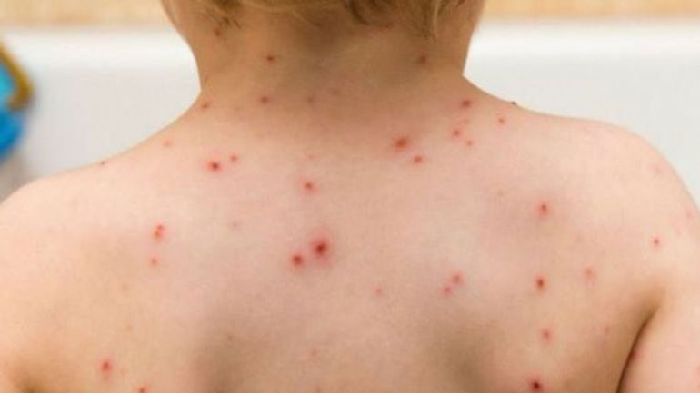 Ανησυχητικά τα κρούσματα ιλαράς στον Έβρο