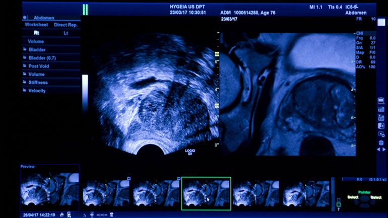 Πρωτοποριακό Σύστημα Υβριδικής Απεικόνισης για τον καρκίνο του προστάτη: Μέγιστη διαγνωστική ακρίβεια και ασφάλεια