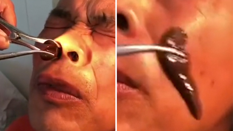 Γιατρός τραβάει γιγάντια βδέλλα από τη μύτη ανθρώπου