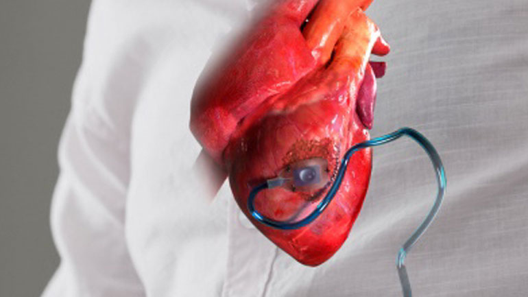 Δημιουργήθηκε η πρώτη συσκευή που εμφυτεύεται στην καρδιά και την προστατεύει έπειτα από έμφραγμα