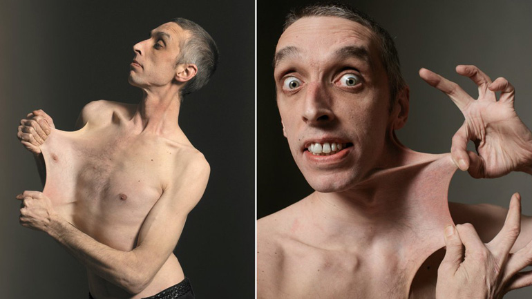 Νεαρός τεντώνει το δέρμα του σαν λάστιχο