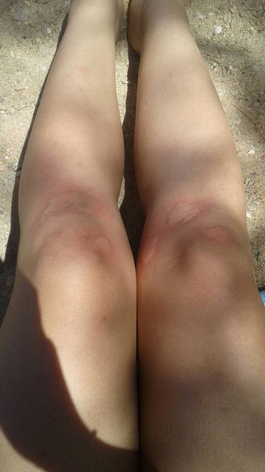 Φωτογραφία από τσίμπημα μέδουσας στην Αντίπαρο (5 Ιουλίου) 