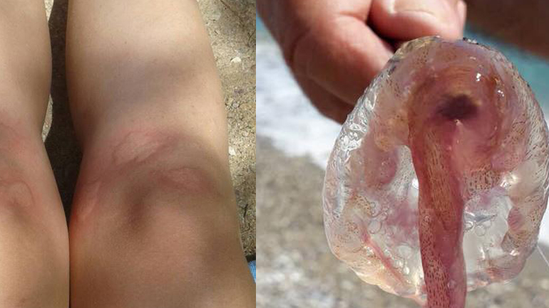 Σε ποιες ακτές ανά την Ελλάδα οι πολίτες καταγράφουν εμφάνιση μεδουσών τον Ιούλιο