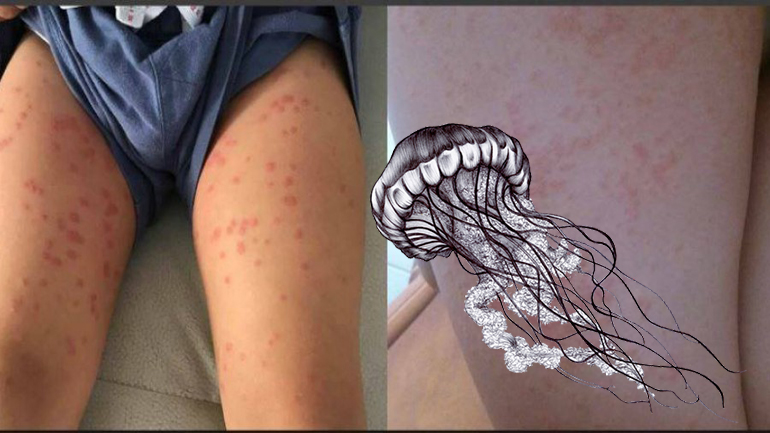 Πανικός με την εμφάνιση μεδουσών σε πολυσύχναστη παραλία της Κύπρου