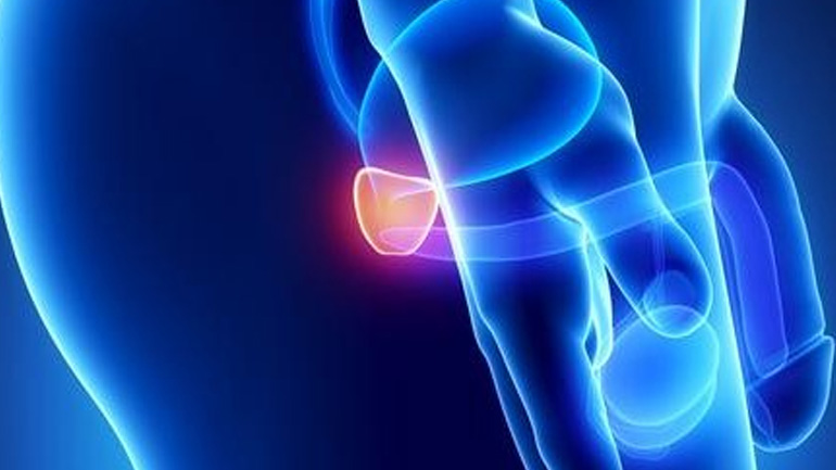 Εναλλακτικοί τρόποι αντιμετώπισης της καλοήθους υπερπλασίας του προστάτη