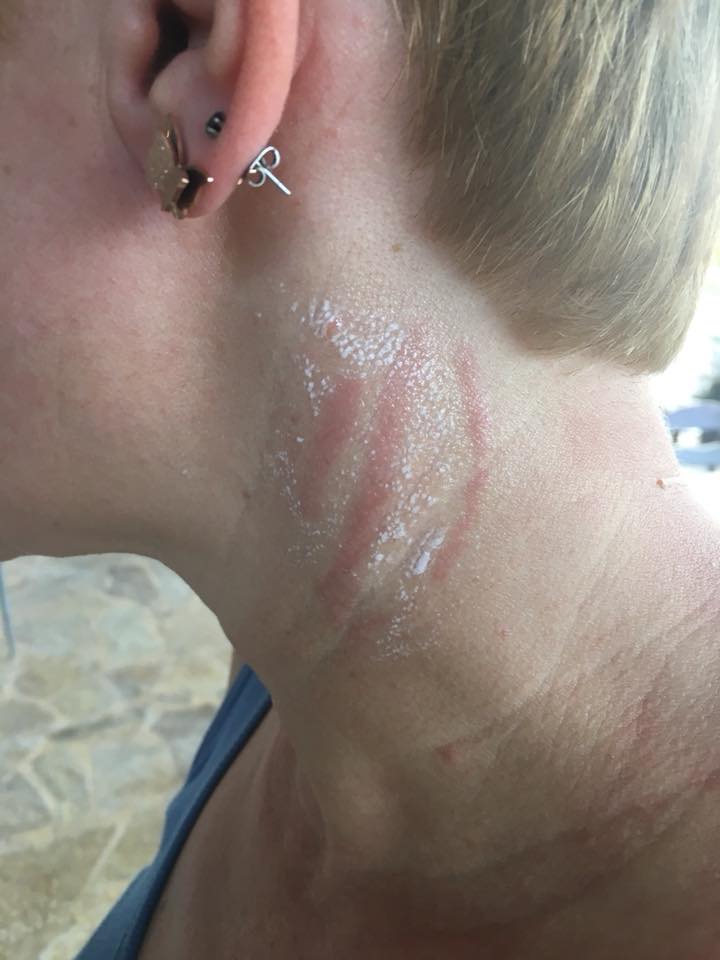 15/7/18 περιοχή Ακράτα - τσίμπημα σε λουόμενη (φωτογραφία από Παρατηρητήριο)