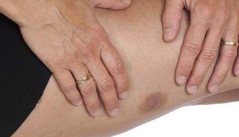 Τρεις τρόποι για να εξαφανίσετε πιο γρήγορα μια μελανιά