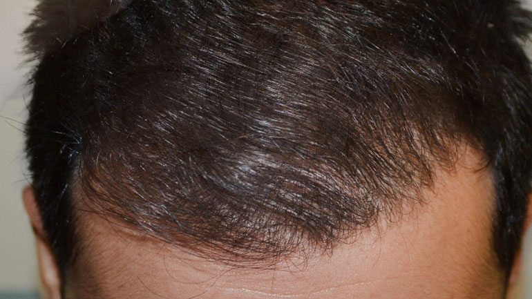 Liberation: Ένα δισ. ευρώ ετησίως αποφέρει ο ιατρικός τουρισμός για μεταμοσχεύσεις μαλλιών στην Τουρκία