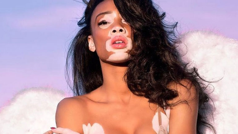 H Winnie Harlow είναι το νέο αγγελάκι της Victoria’s Secret – Ξέσπασε σε κλάματα η καλλονή