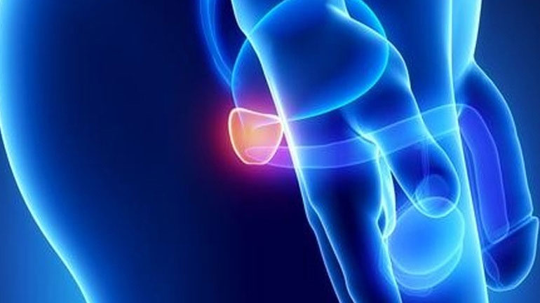 Η καλοήθης υπερπλασία του προστάτη και ο εμβολισμός των προστατικών αρτηριών Η καλοήθης υπερπλασία του προστάτη και ο εμβολισμός των προστατικών αρτηριών