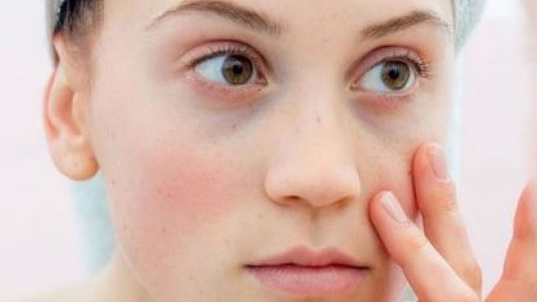 Πείτε τέλος στους μαύρους κύκλους και στις σακούλες κάτω από τα μάτια με αυτές τις τροφές!