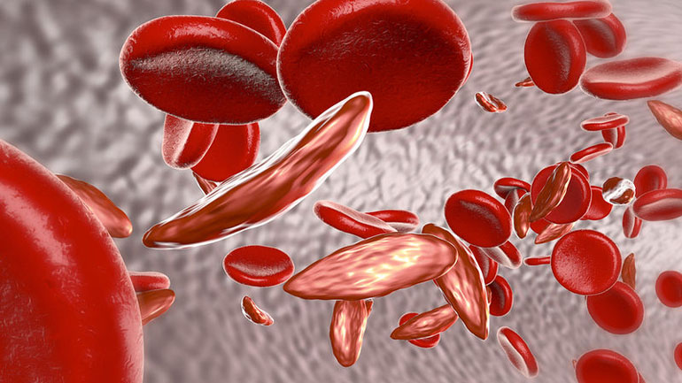 Νέες θεραπείες για μεσογειακή και δρεπανοκυτταρική αναιμία