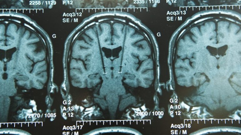 To 40% των ασθενών με κολπική μαρμαρυγή έχει σιωπηλές εγκεφαλικές βλάβες