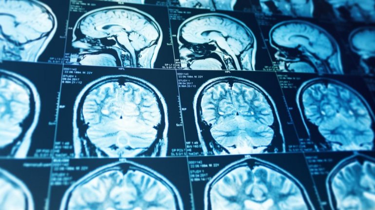 Τεστ προβλέπει την μακροπρόθεσμη έκβαση έπειτα από ένα εγκεφαλικό