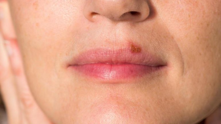 Προκαλεί ο έρπης τη νόσο Αλτσχάιμερ;