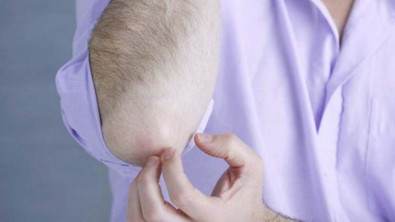 Αποτελεσματικό το μοντέλο παροχής online φροντίδας για τη θεραπεία της ψωρίασης