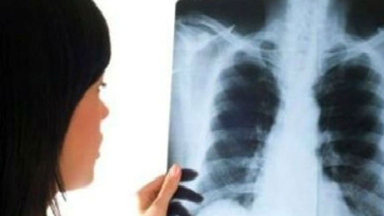 Φυματίωση και AIDS τα πιο θανατηφόρα νοσήματα!