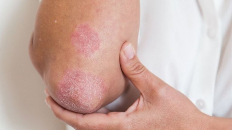 Πώς συνδέονται οι αυτοάνοσες και οι καρδιαγγειακές παθήσεις